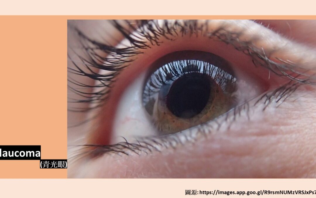 青光眼 (Glaucoma)